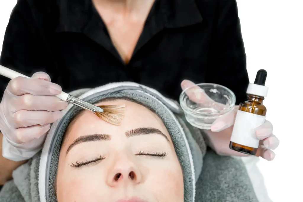 chemical peel